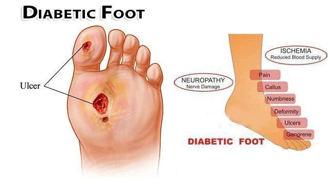 diabetic foot examination